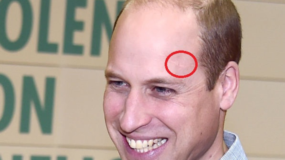 Истината за мистериозния белег на челото на принц Уилям