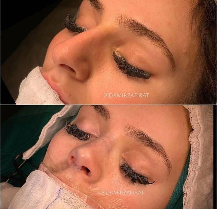 Появиха се снимки на Преслава на операционната маса (Вижте как оперират носа й)