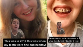  Шокиращи фотоси на зъбите на момиче, пиещо газирано с години 