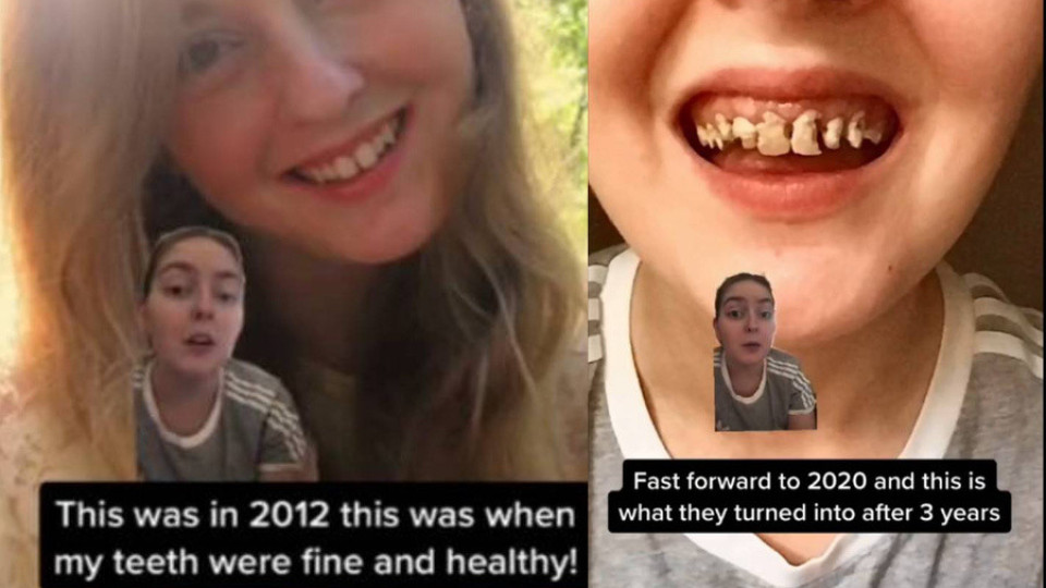 Шокиращи снимки на зъбите на момиче, пиещо газирано с години