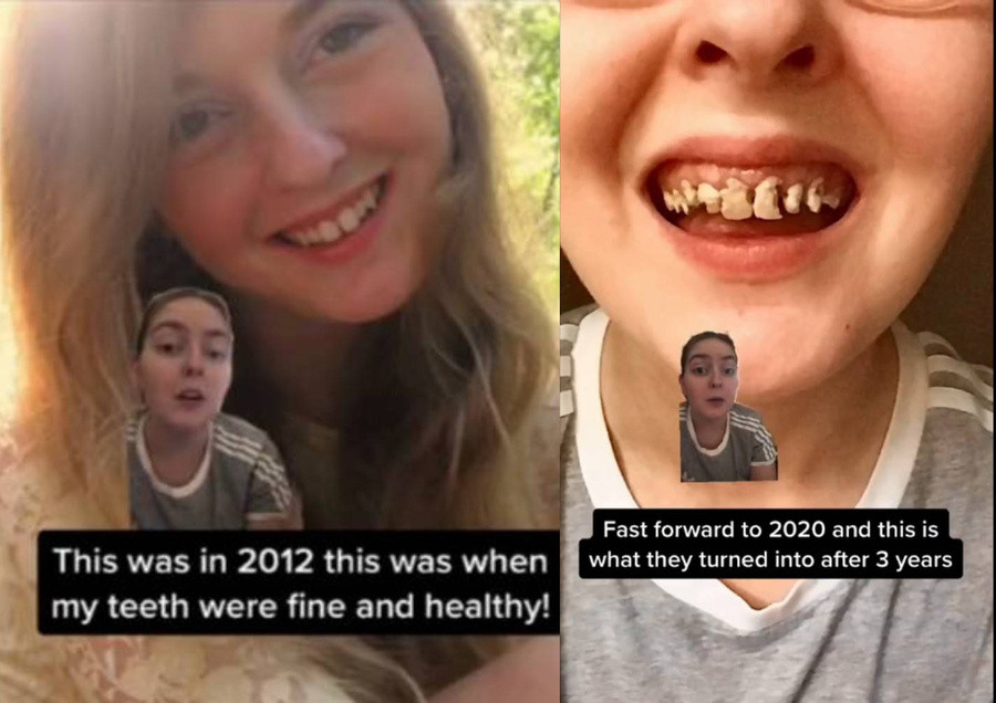 Шокиращи снимки на зъбите на момиче, пиещо газирано с години