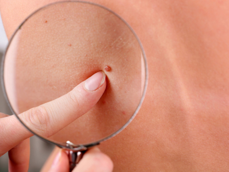 Важни 4 симптома, които са предвестник на рак на кожата - Снимка 2