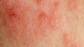 Важни 4 симптома, които са предвестник на рак на кожата