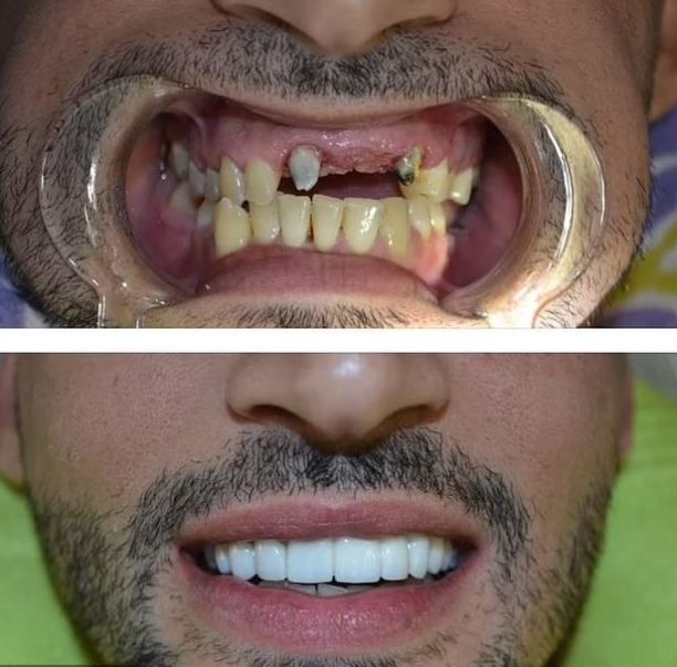Мъжът на Бритни Спиърс  преди - неузнавам  (Иранският емигрант тежеше 130 кила и бе с развалени зъби (Как се преобрази Сам Асгари – Снимки) - Снимка 4