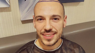 Турска клиника прецака Даниел Петканов и си ходи плешив