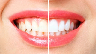 Перфектни зъби със снежна белота? Решението са фасети