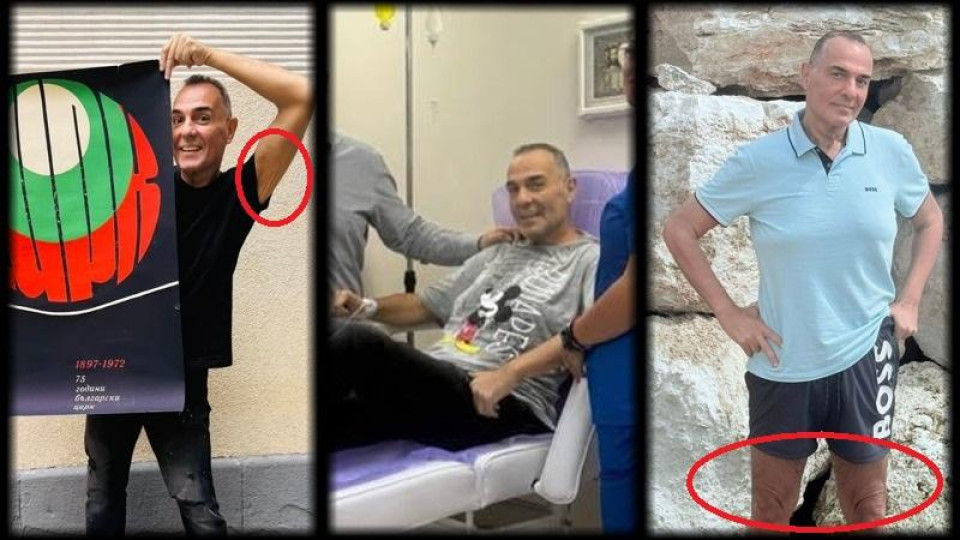 Драго Чая призна: Свалих 50 кг. с операцията, но кожата ми увисна потресаващо! Не е за гледане! (още подробности)